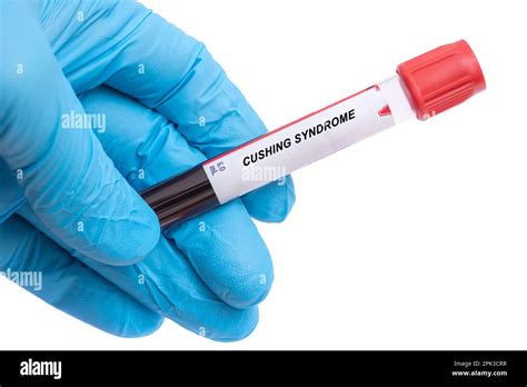 lushings compression test|blood draw for cushing's syndrome.